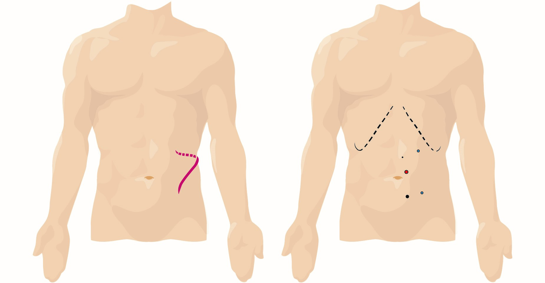 Robotic Assisted Partial Nephrectomy (RAPN) – GM Urology