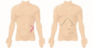 Difference between key hole and open incisions