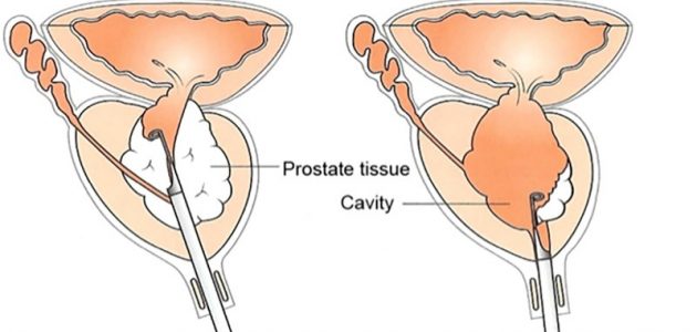 Transurethral Resection Of Prostate Turp Gm Urology