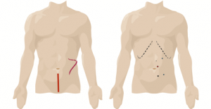 Open vs Robotic incisions