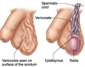 Varicocele