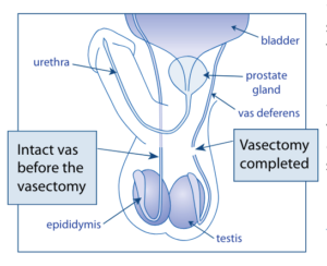 Vasectomy Reversal